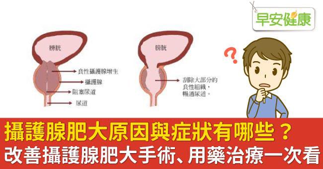 攝護腺肥大的患者不建議一次服用兩顆犀利士5mg,避免引起副作用